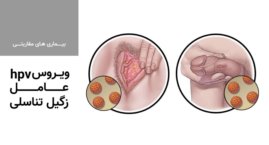 ویروس hpv عامل زگیل تناسلی